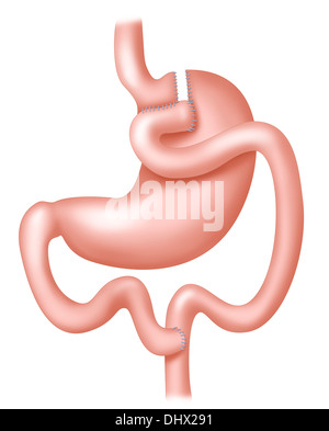 BYPASS GASTRICO Foto Stock