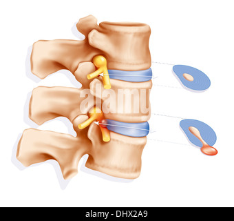 Ernia del disco, illustrazione Foto Stock