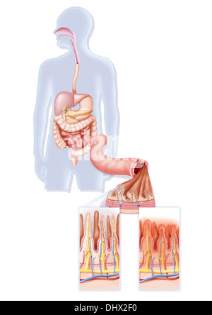 MALATTIA CELIACA Foto Stock