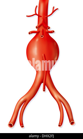 Aneurisma di una arteria, disegno Foto Stock