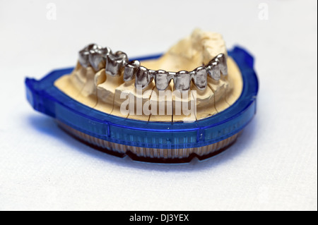 Finito il telaio in metallo per corone in ceramica Foto Stock