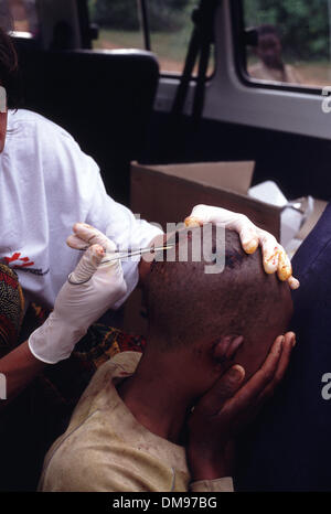 08 apr 1994 - Il Burundi e il Ruanda - infermiera di MSF tratta preda di machete woundon del Ruanda Burundi confine come Tutsi ruandesi rifugiati fuggono attraverso la frontiera con il Burundi in aprile 1994 come gli Hutu impegnato il genocidio in cento giorni di guerra civile. Il genocidio ruandese è stato il 1994 omicidi di massa di una stima che 800.000 persone nel piccolo Oriente nazione africana del Rwanda. Nel corso del approximat Foto Stock