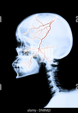 Immagine a raggi X di una testa umana con un fulmine nel cranio. Foto Stock