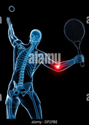 Il gomito del tennista, artwork Foto Stock