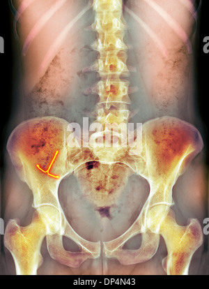 Ectopico contraccettivi IUD, X-ray Foto Stock