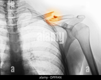 X-ray mostra clavicola fratturata Foto Stock