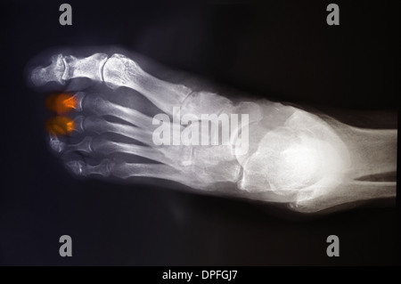 X-ray del piede deformità ossee nel diabete Foto Stock