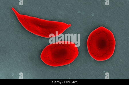 SEM di falce e di cellule normali cellule rosse del sangue Foto Stock
