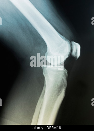 Ginocchio normale x-ray di 39 anno vecchio Foto Stock
