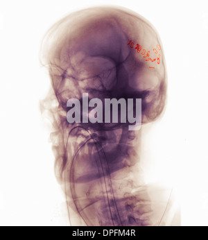 Cranio x-ray dell uomo in un incidente in moto Foto Stock