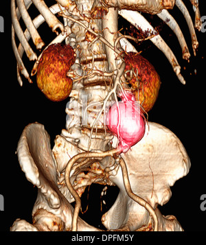 CT scan image mostra un aneurisma aortico addominale Foto Stock