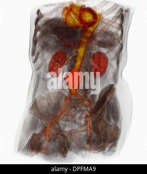 CT scan image mostra un aneurisma aortico addominale Foto Stock