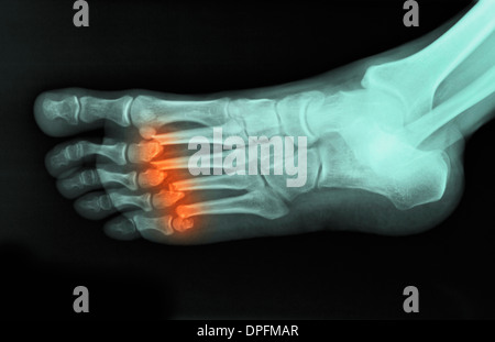 X-ray del piede che mostra metatarsals fratturati Foto Stock