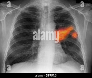 I raggi x al torace di un fumatore che mostra il cancro ai polmoni Foto Stock