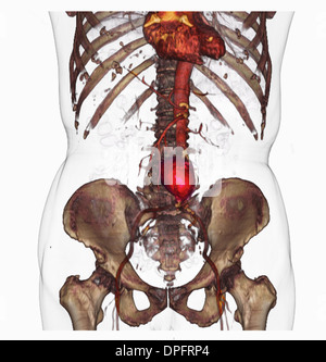 CT scan image mostra un aneurisma aortico addominale Foto Stock