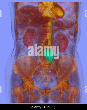 CT scan image mostra un aneurisma aortico addominale Foto Stock