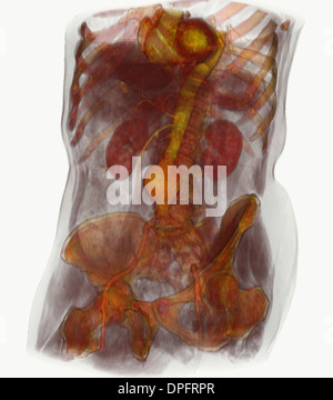 CT scan image mostra un aneurisma aortico addominale Foto Stock