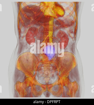 CT scan image mostra un aneurisma aortico addominale Foto Stock