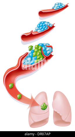 La metastasi, disegno Foto Stock