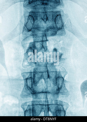 La metastasi, vertebre lombari Foto Stock