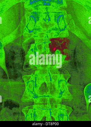 La metastasi, vertebre lombari Foto Stock