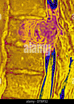 La metastasi, vertebre lombari Foto Stock