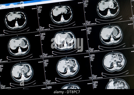 Scansione TC di sano 58 anno vecchia donna. NB: il testo è stato resi anonimi per preservare la privacy. Foto Stock