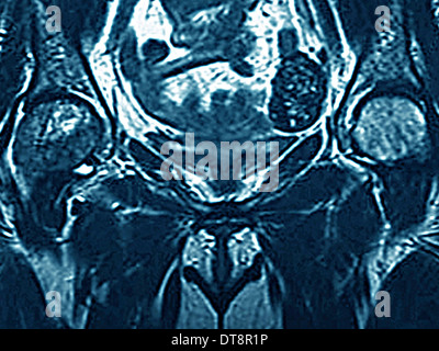 Metastasi ossee, MRI Foto Stock