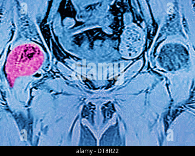 Metastasi ossee, MRI Foto Stock