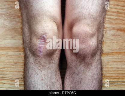 La cicatrice sul suo ginocchio della gamba dopo un intervento chirurgico in ospedale Foto Stock