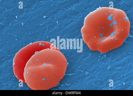 Anemia falciforme sem Foto Stock