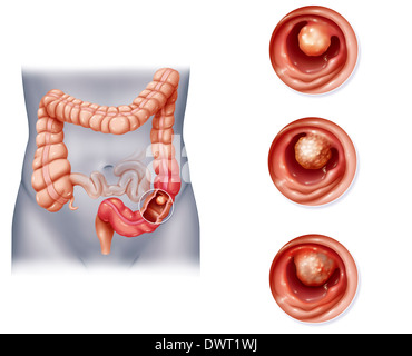 Il cancro del colon, disegno Foto Stock