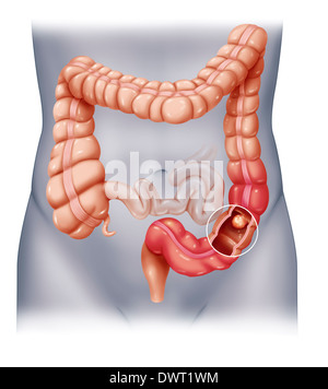 Il cancro del colon, disegno Foto Stock