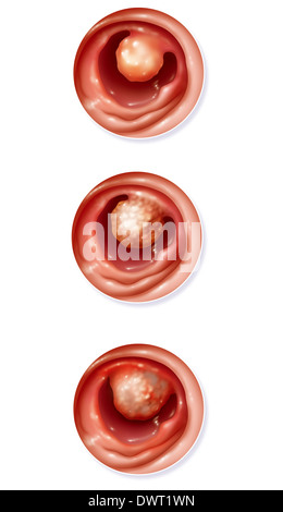 Il cancro del colon, disegno Foto Stock