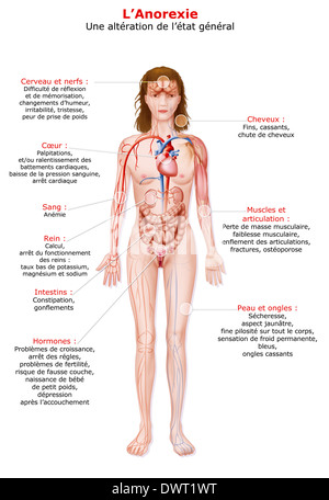 Anoressia, disegno Foto Stock