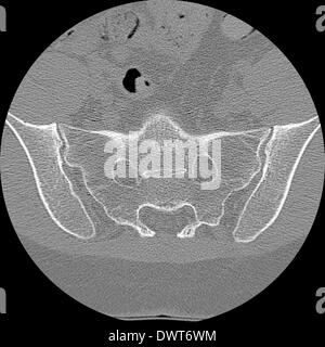 Scanner sacroiliac joint Foto Stock