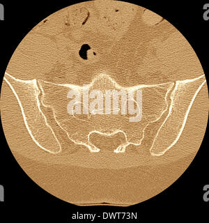 Scanner sacroiliac joint Foto Stock