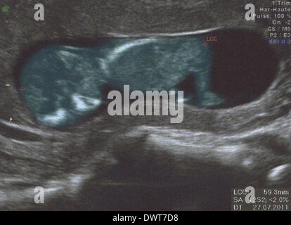 Feto di scansione ad ultrasuoni Foto Stock