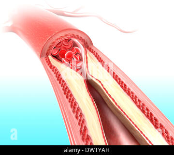 Disegno dell'arteriosclerosi Foto Stock