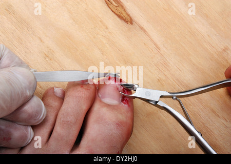 La chirurgia sanguinamento rotto la gamba unghia Foto Stock