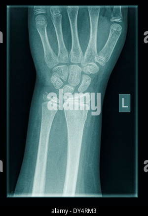 X-ray del polso di 9 anno vecchio paziente di sesso maschile con distale di radio e ulna fratture Foto Stock