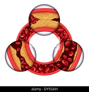 La malattia delle arterie coronarie concetto medico come una vena di circolare con la progressiva formazione di placca risultante in arterie intasate e aterosclerosi con con un tridimensionale di anatomia umana schema che mostra i rischi di accumulo di colesterolo. Foto Stock