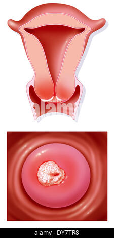 Il cancro cervicale, disegno Foto Stock