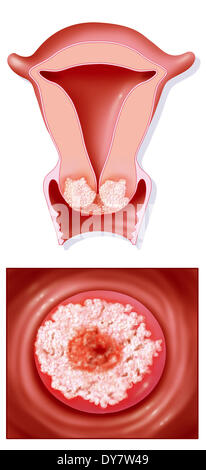 Il cancro cervicale, disegno Foto Stock