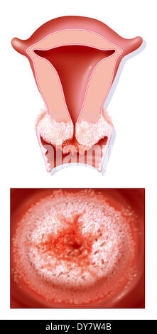 Il cancro cervicale, disegno Foto Stock