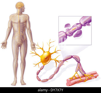 La sclerosi multipla Foto Stock