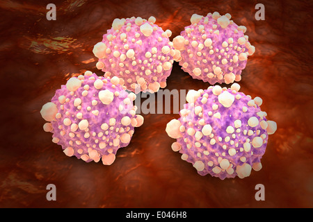 Vista Microscipic delle cellule del tumore pancreatico. Foto Stock