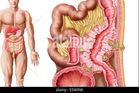 Illustrazione di la diverticolosi del colon. Foto Stock