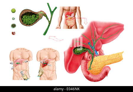 Medical illustrazione che mostra i calcoli biliari nella cistifellea e la rimozione chirurgica della cistifellea, noto come la colecistectomia. Foto Stock