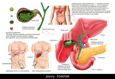 Medical illustrazione che mostra i calcoli biliari nella cistifellea e la rimozione chirurgica della cistifellea, noto come la colecistectomia. Foto Stock